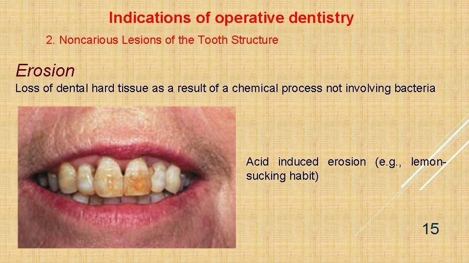 Indications of operative dentistry 2. Noncarious Lesions of the Tooth Structure Erosion Loss of