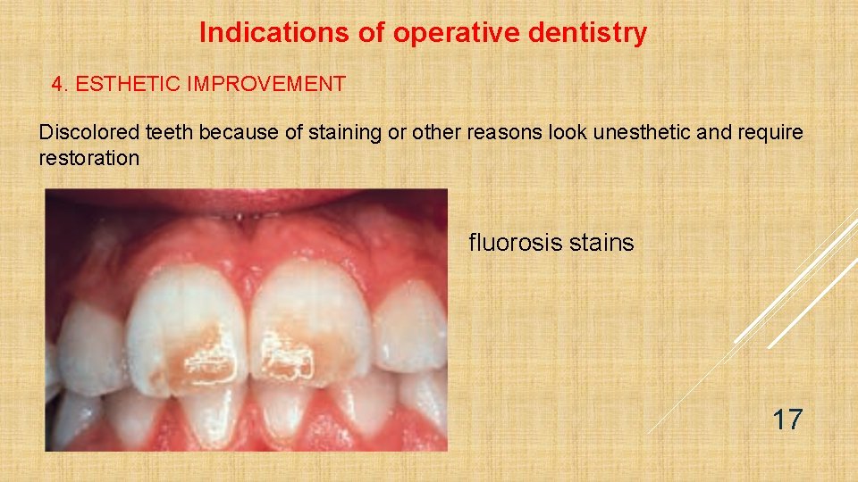 Indications of operative dentistry 4. ESTHETIC IMPROVEMENT Discolored teeth because of staining or other