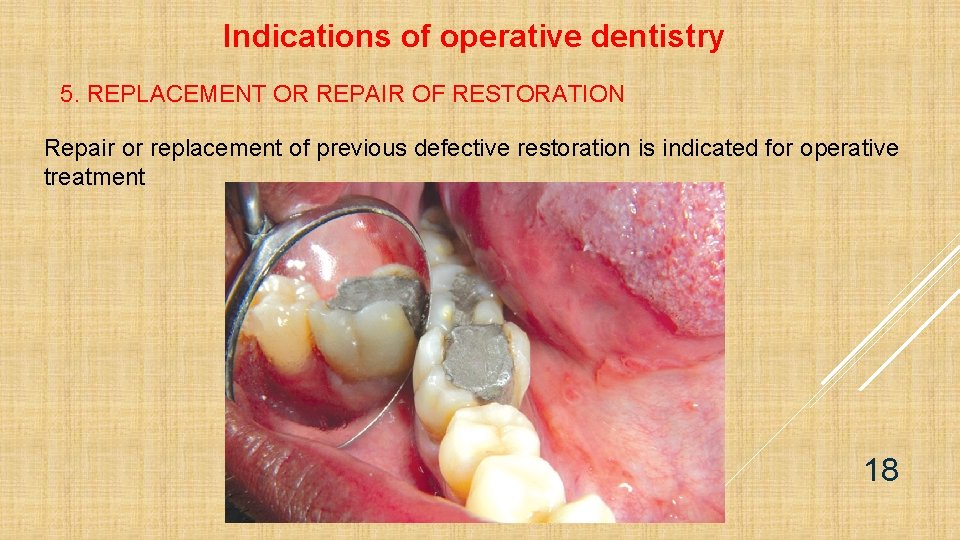 Indications of operative dentistry 5. REPLACEMENT OR REPAIR OF RESTORATION Repair or replacement of