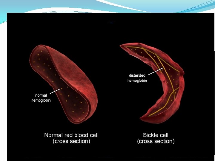 Sickle Cell in a Genetic Context 11 Hemoglobin Molecules T Sickle Cell in a Genetic Context 11 Hemoglobin Molecules T