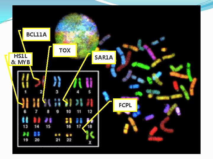 Sickle Cell in a Genetic Context BCL 11 A HS 1 L & MYB Sickle Cell in a Genetic Context BCL 11 A HS 1 L & MYB