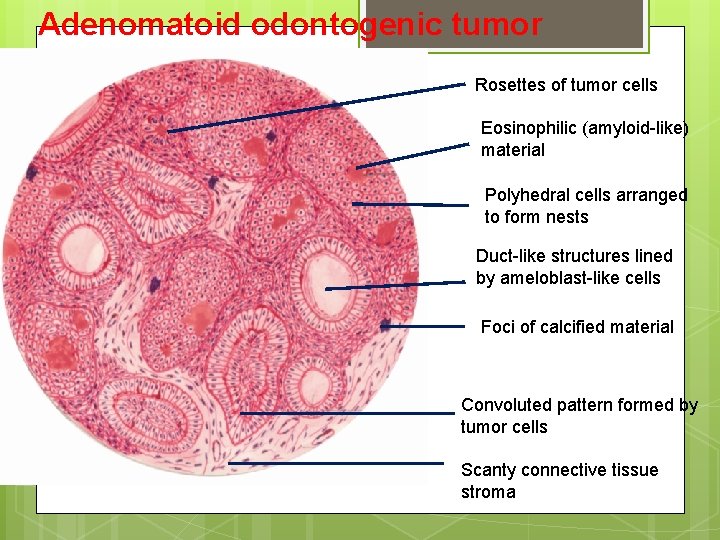 Odontogenic tumours ADENOMATOID ODONTOGENIC TUMOR Adenoameloblastoma ...