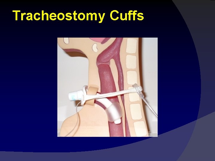 Tracheostomy Cuffs 