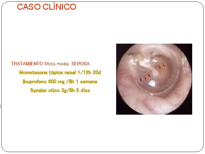 CASO CLÍNICO TRATAMIENTO Otitis media SEROSA Mometasona tópica nasal 1/12 h 20 d Ibuprofeno