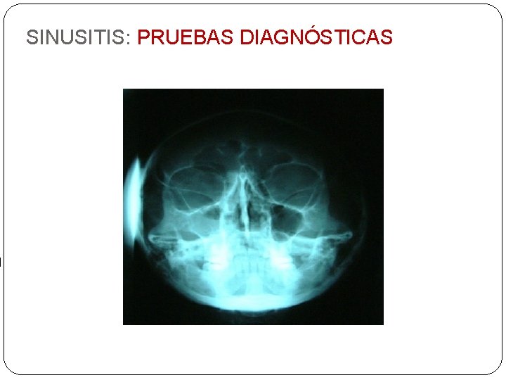 SINUSITIS: PRUEBAS DIAGNÓSTICAS 