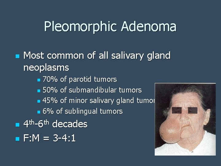 Pleomorphic Adenoma n Most common of all salivary gland neoplasms 70% of parotid tumors
