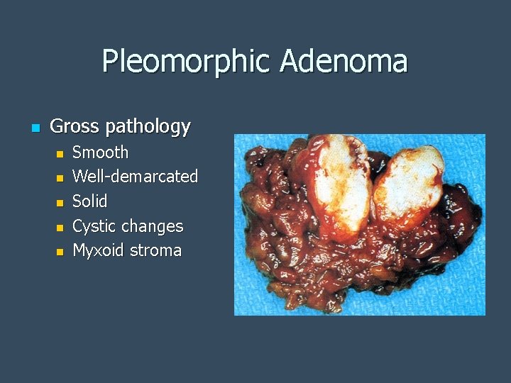 Pleomorphic Adenoma n Gross pathology n n n Smooth Well-demarcated Solid Cystic changes Myxoid