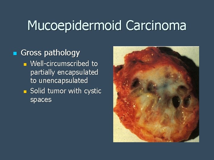 Mucoepidermoid Carcinoma n Gross pathology n n Well-circumscribed to partially encapsulated to unencapsulated Solid