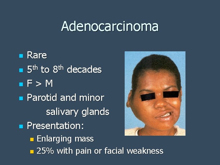 Adenocarcinoma n n n Rare 5 th to 8 th decades F>M Parotid and