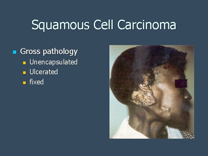 Squamous Cell Carcinoma n Gross pathology n n n Unencapsulated Ulcerated fixed 