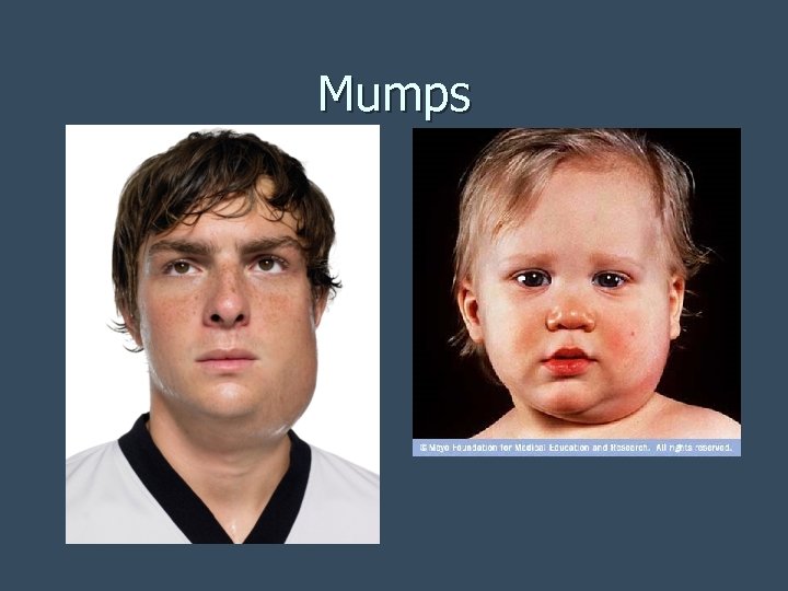 Mumps 