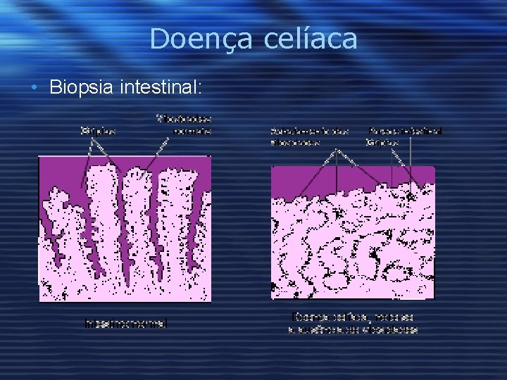 Doença celíaca • Biopsia intestinal: 