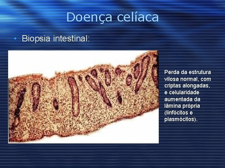 Doença celíaca • Biopsia intestinal: Perda da estrutura vilosa normal, com criptas alongadas, e