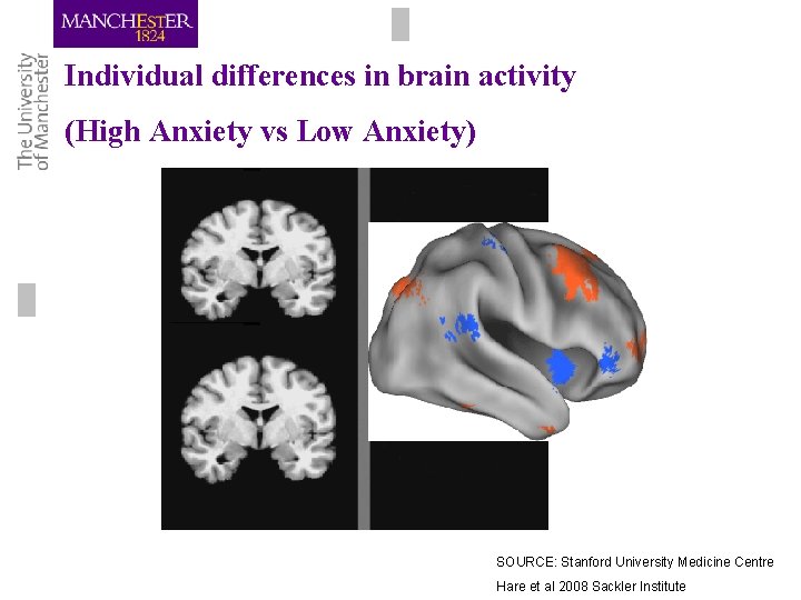 Individual differences in brain activity (High Anxiety vs Low Anxiety) SOURCE: Stanford University Medicine Individual differences in brain activity (High Anxiety vs Low Anxiety) SOURCE: Stanford University Medicine