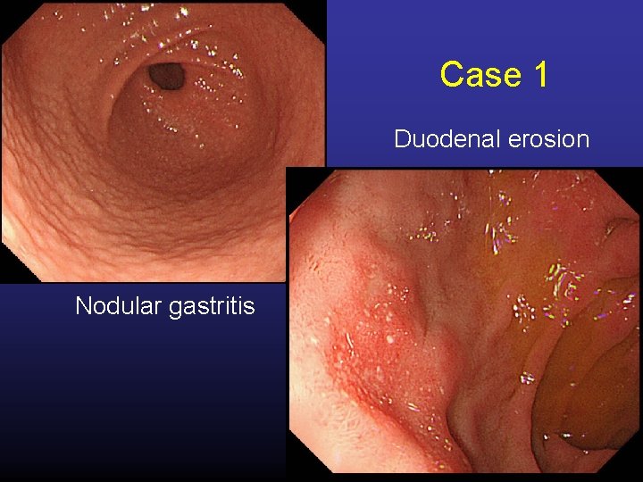 Case 1 Duodenal erosion Nodular gastritis 