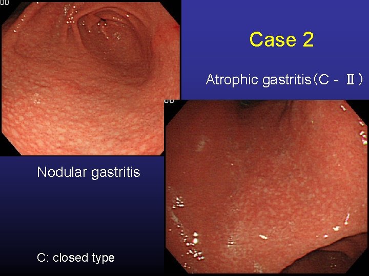 Case 2 Atrophic gastritis（C‐Ⅱ） Nodular gastritis C: closed type 