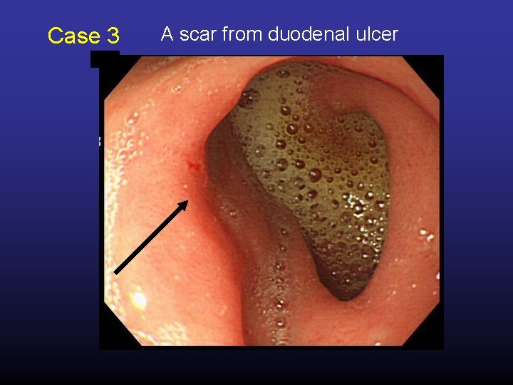 Case 3 A scar from duodenal ulcer 
