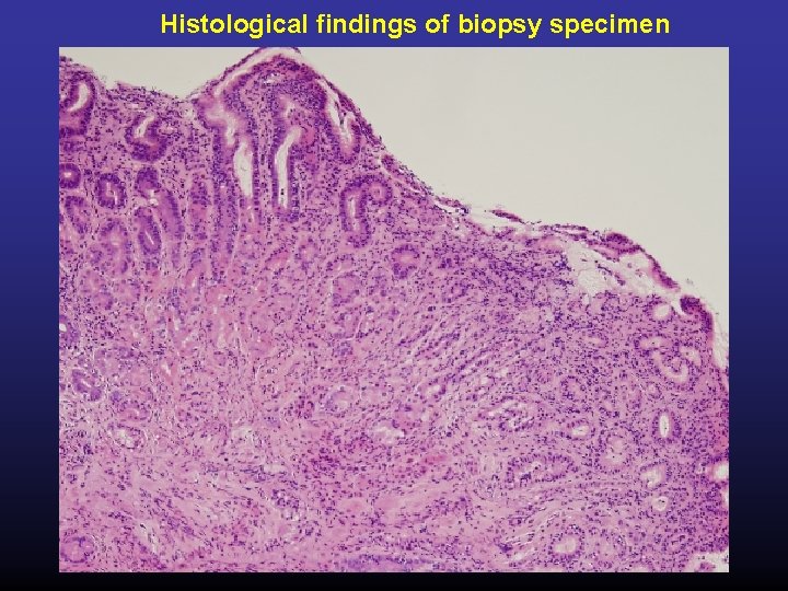 Histological findings of biopsy specimen 