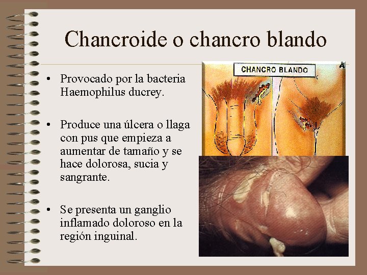 Chancroide o chancro blando • Provocado por la bacteria Haemophilus ducrey. • Produce una