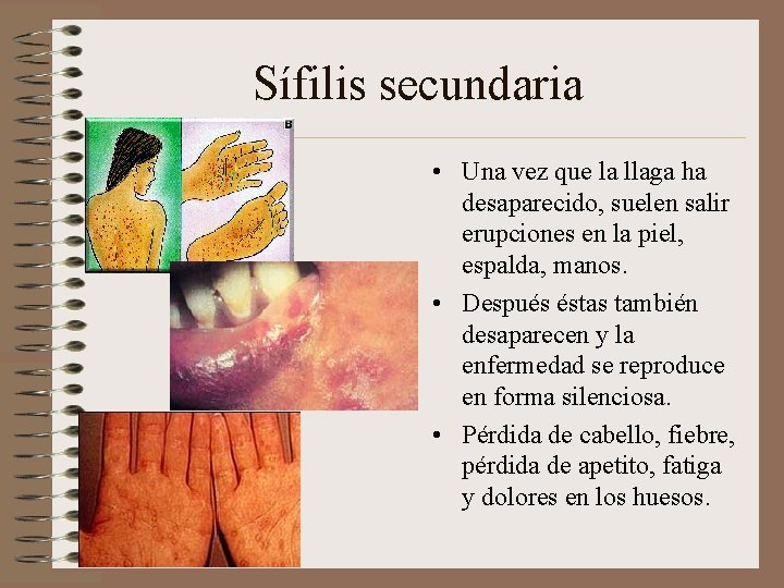 Sífilis secundaria • Una vez que la llaga ha desaparecido, suelen salir erupciones en