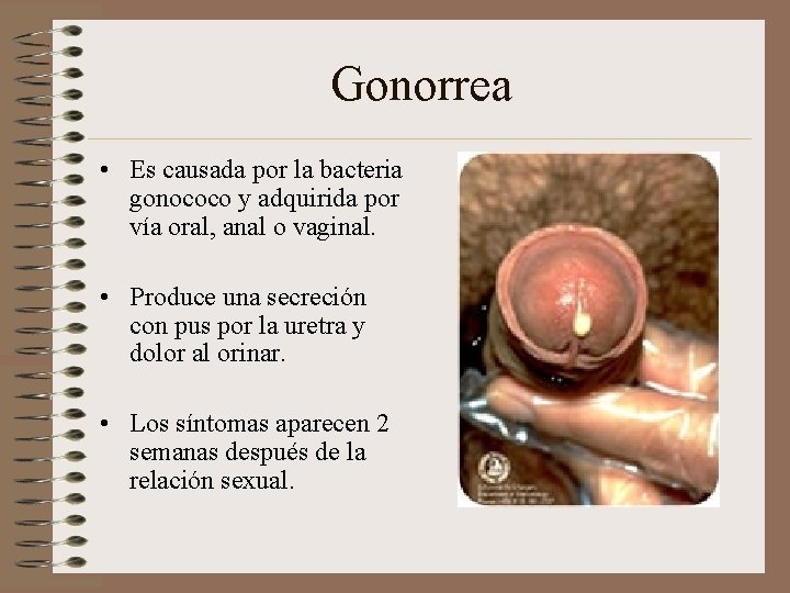 Gonorrea • Es causada por la bacteria gonococo y adquirida por vía oral, anal