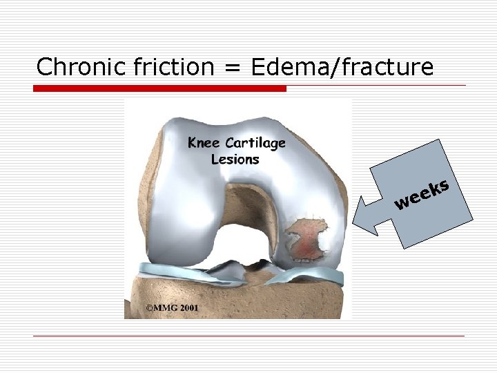 Chronic friction = Edema/fracture w ks e e 