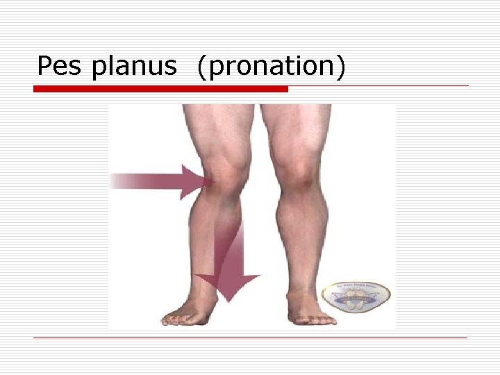 Pes planus (pronation) 