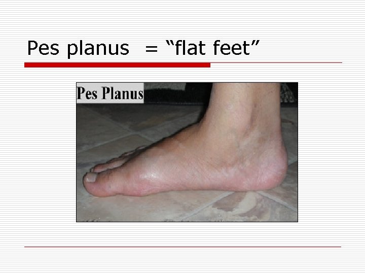 Pes planus = “flat feet” 