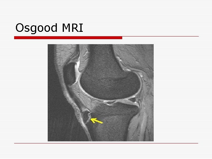 Osgood MRI 