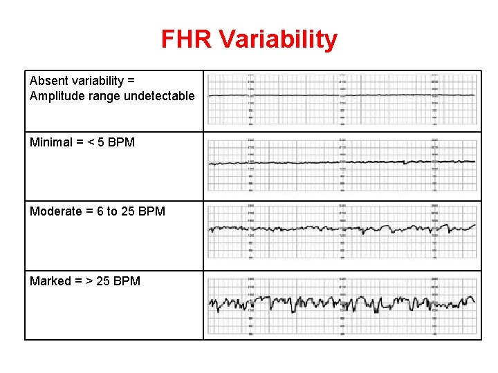 FHR Variability Absent variability = Amplitude range undetectable Minimal = < 5 BPM Moderate