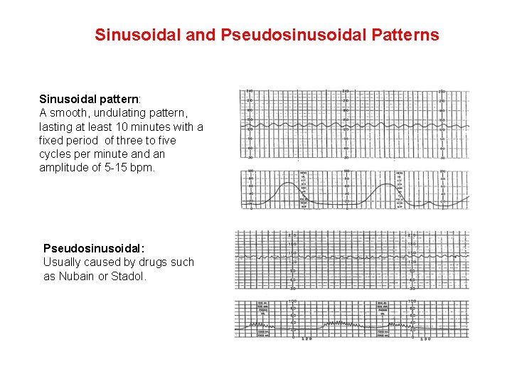 Sinusoidal and Pseudosinusoidal Patterns Sinusoidal pattern: A smooth, undulating pattern, lasting at least 10