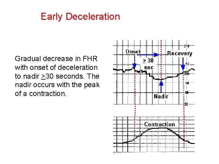 Early Deceleration Gradual decrease in FHR with onset of deceleration to nadir >30 seconds.