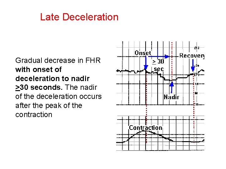 Late Deceleration Gradual decrease in FHR with onset of deceleration to nadir >30 seconds.