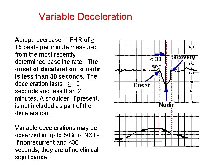 Variable Deceleration Abrupt decrease in FHR of > 15 beats per minute measured from