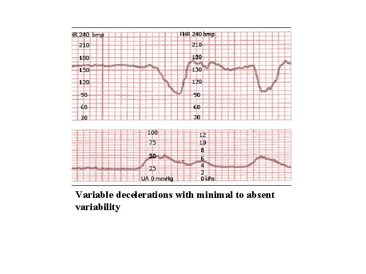 Variable decelerations with minimal to absent variability 