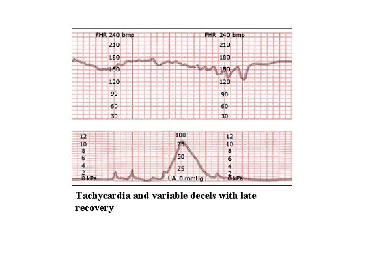 Tachycardia and variable decels with late recovery 
