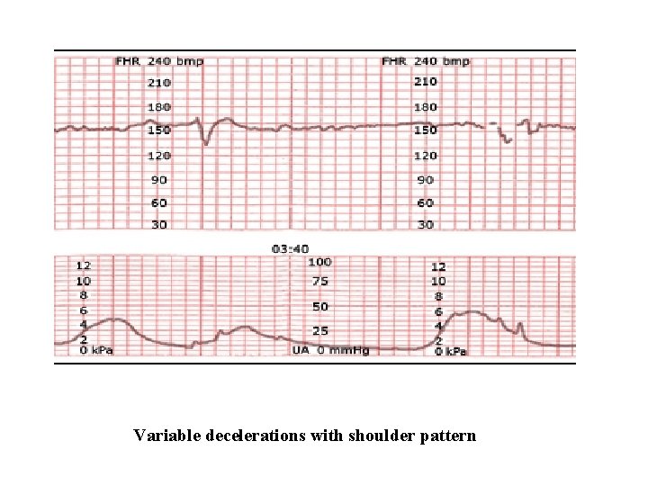 Variable decelerations with shoulder pattern 