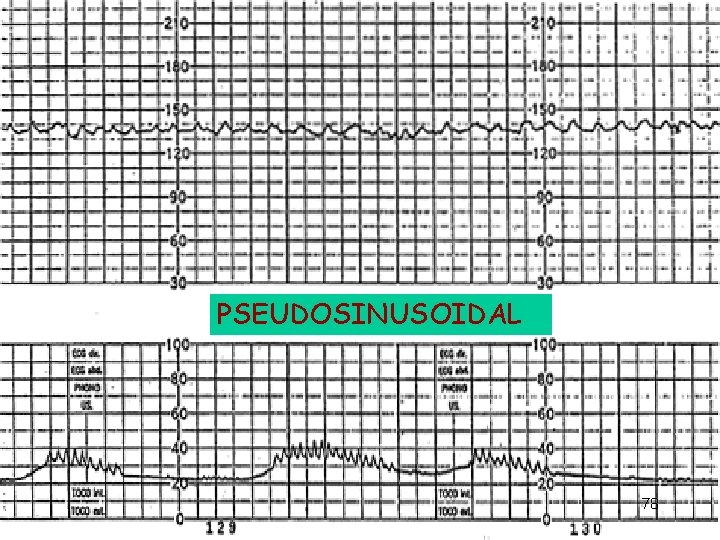 PSEUDOSINUSOIDAL 78 