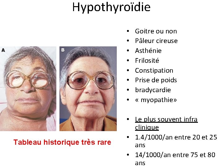 Hypothyroïdie • • Tableau historique très rare Goitre ou non Pâleur cireuse Asthénie Frilosité