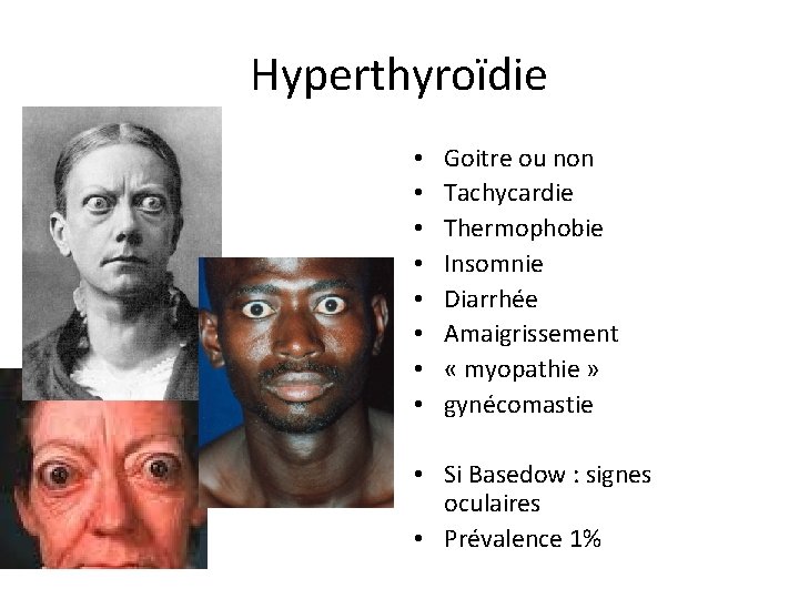 Hyperthyroïdie • • Goitre ou non Tachycardie Thermophobie Insomnie Diarrhée Amaigrissement « myopathie »