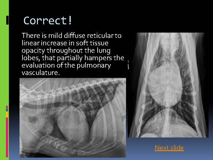 Correct! There is mild diffuse reticular to linear increase in soft tissue opacity throughout