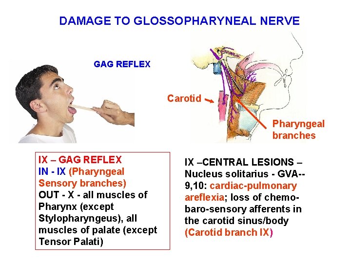 DAMAGE TO GLOSSOPHARYNEAL NERVE GAG REFLEX Carotid Pharyngeal branches IX – GAG REFLEX IN