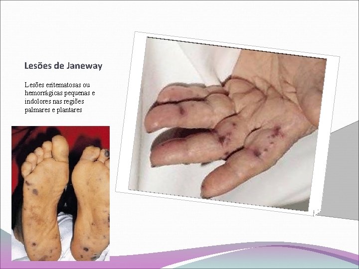 Lesões de Janeway Lesões eritematosas ou hemorrágicas pequenas e indolores nas regiões palmares e