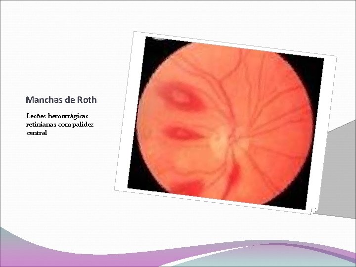 Manchas de Roth Lesões hemorrágicas retinianas com palidez central 