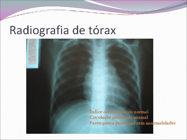 Radiografia de tórax Índice cardiotorácico normal Circulação pulmonar normal Parênquima pulmonar sem anormalidades 