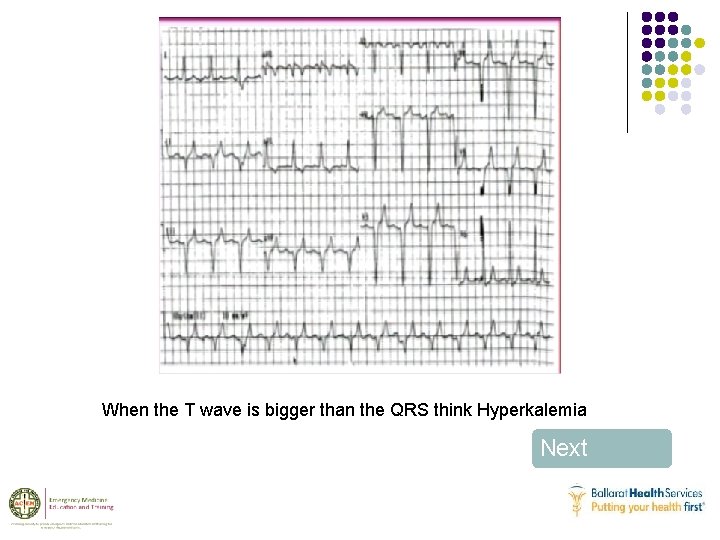 When the T wave is bigger than the QRS think Hyperkalemia Next 