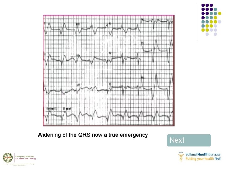 Widening of the QRS now a true emergency Next 
