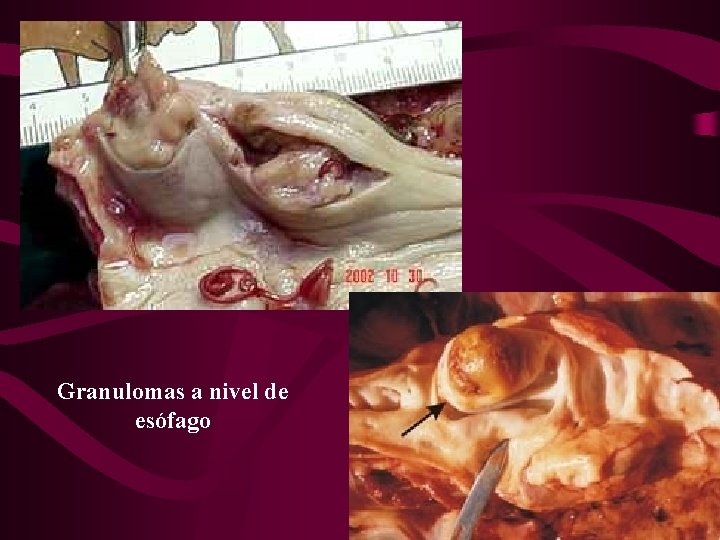 Granulomas a nivel de esófago 