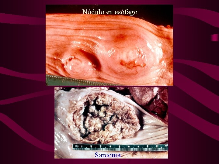 Nódulo en esófago Sarcoma 