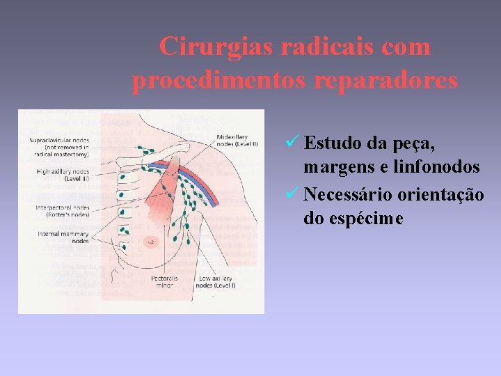 Cirurgias radicais com procedimentos reparadores ü Estudo da peça, margens e linfonodos ü Necessário